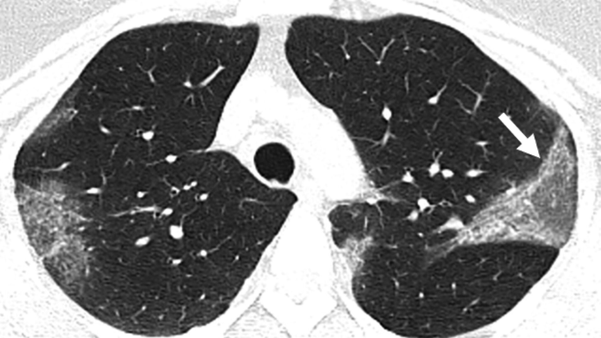 skynews rnas coronavirus lung 4945907