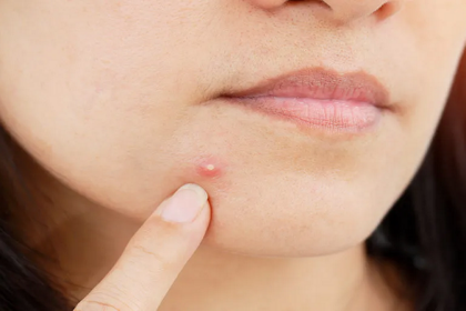 Pimples appear on your face because of this small mistake of yours! Learn how to avoid it