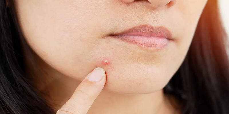 Pimples appear on your face because of this small mistake of yours! Learn how to avoid it