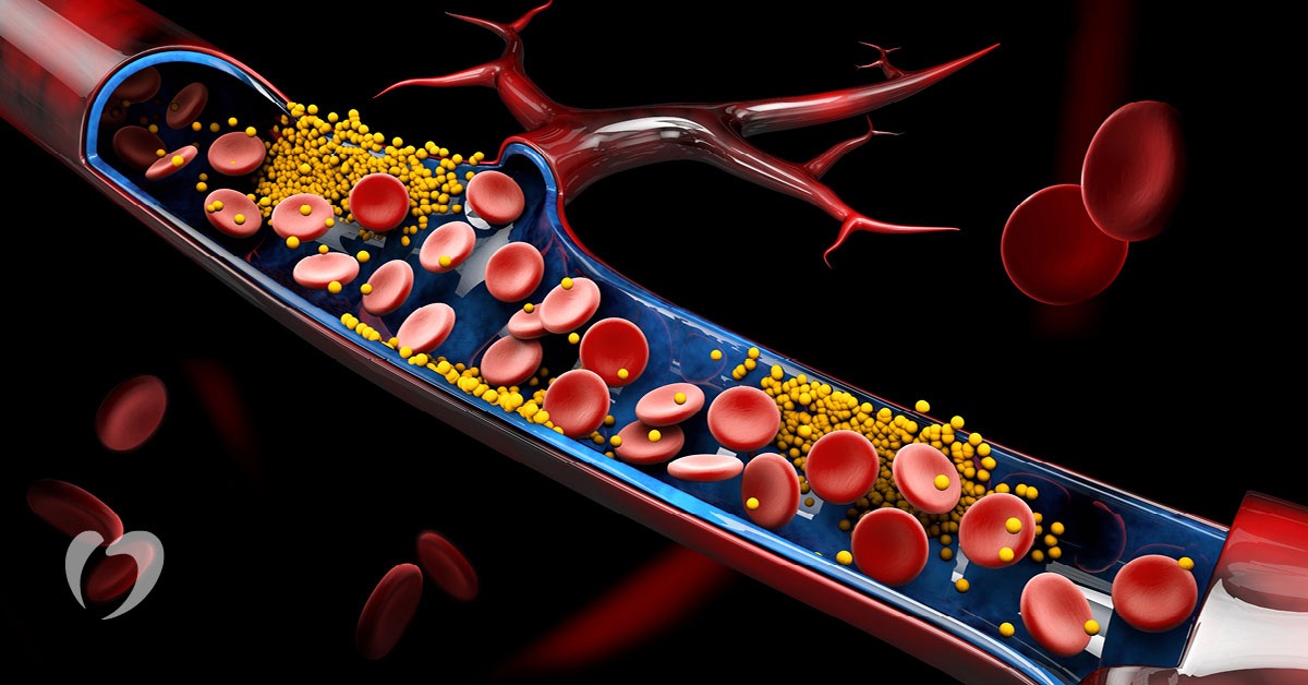 If these symptoms appear in the body, be careful! May be high cholesterol