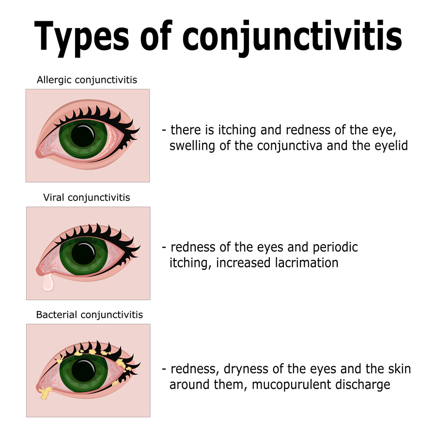 conjunctivitis spread by looking શું આંખનો ફલૂ કન્જકટીવાઇટીસ ખરેખર