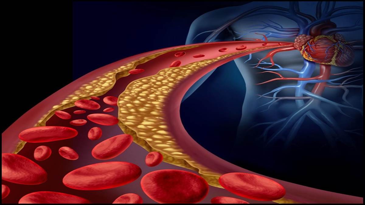 11 07 2022 high cholesterol