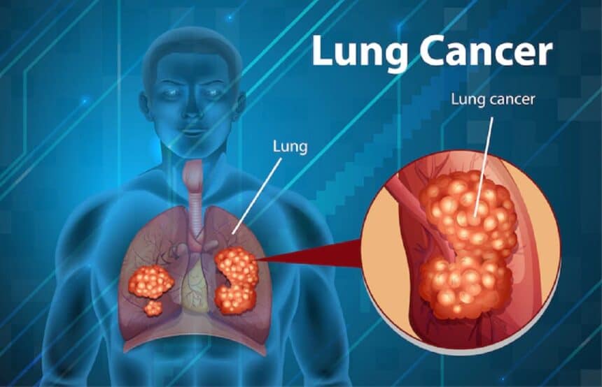 lung cancer