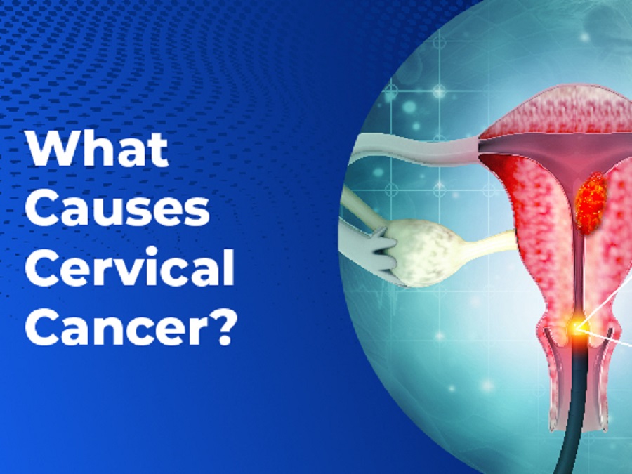 Cervical Cancer