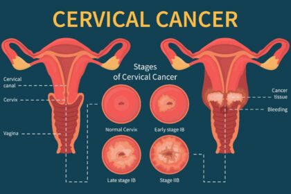 Cervical cancer