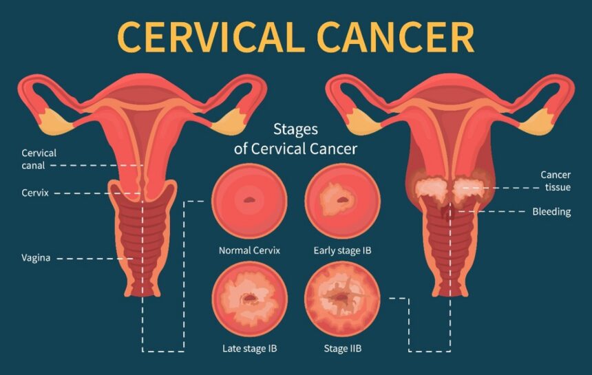 Cervical cancer