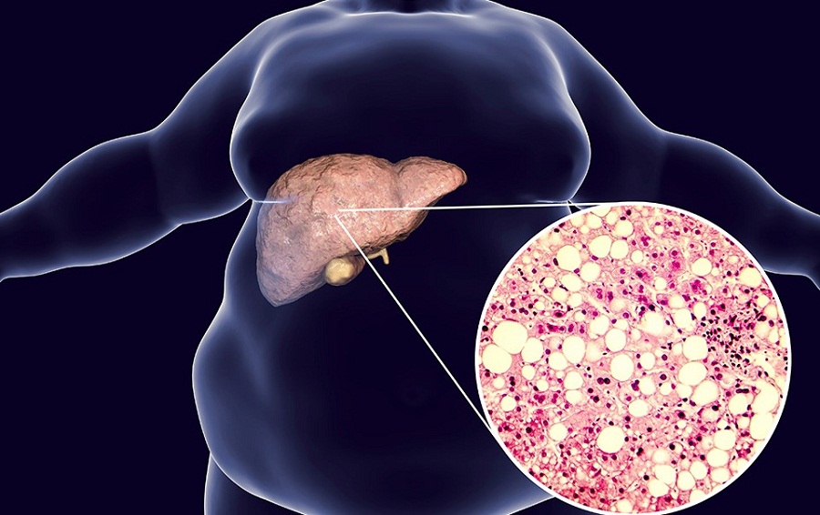 Fatty Liver